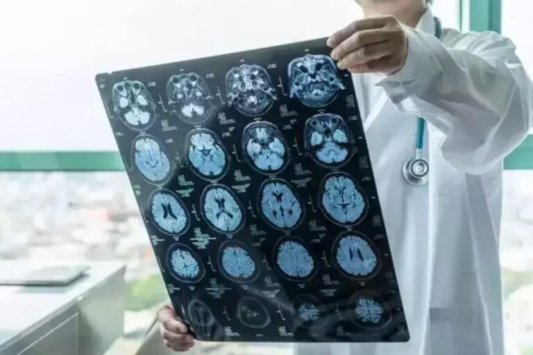 alzheimer