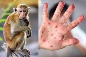 Mpox Disease in India