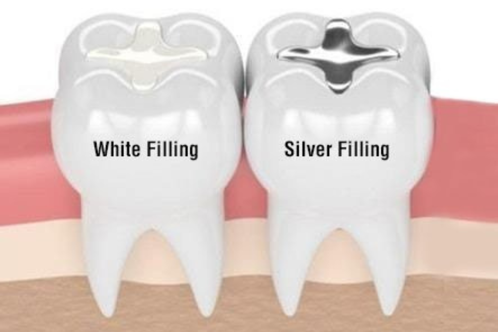 White Fillings vs. Silver Fillings